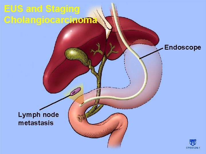 EUS and Staging Cholangiocarcinoma Endoscope Lymph node metastasis CP 1041236 -1 EUS and Staging Cholangiocarcinoma Endoscope Lymph node metastasis CP 1041236 -1