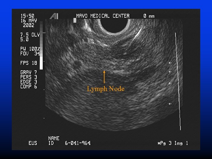 Lymph Node 