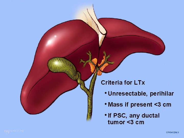 Criteria for LTx • Unresectable, perihilar • Mass if present <3 cm • If