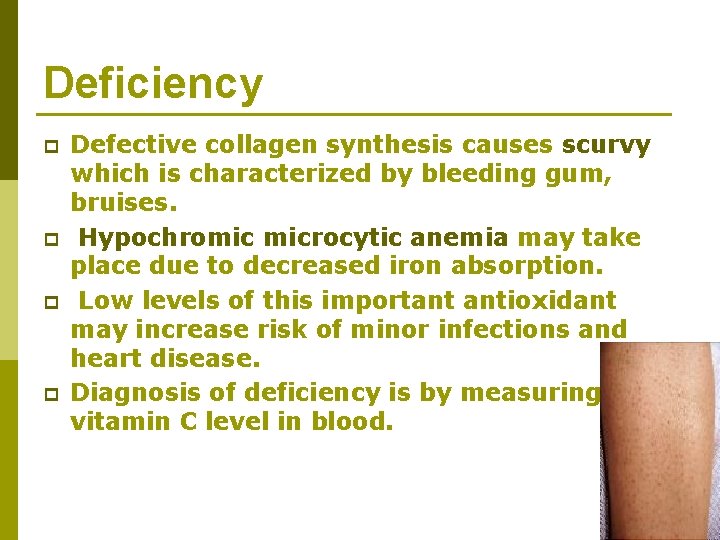 Deficiency p p Defective collagen synthesis causes scurvy which is characterized by bleeding gum,