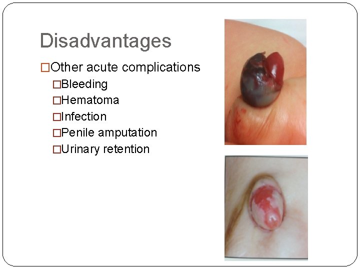 Disadvantages �Other acute complications �Bleeding �Hematoma �Infection �Penile amputation �Urinary retention 