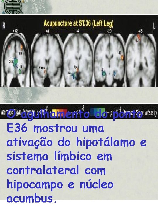 O agulhamento do ponto E 36 mostrou uma ativação do hipotálamo e sistema límbico