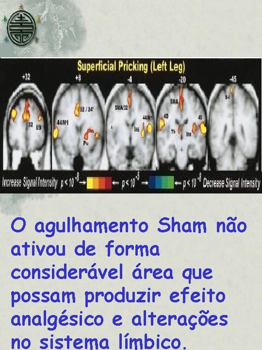 O agulhamento Sham não ativou de forma considerável área que possam produzir efeito analgésico