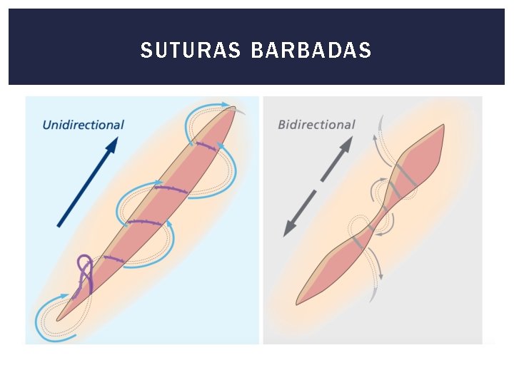 SUTURAS BARBADAS 