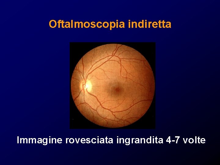 Oftalmoscopia indiretta Immagine rovesciata ingrandita 4 -7 volte Oftalmoscopia indiretta Immagine rovesciata ingrandita 4 -7 volte