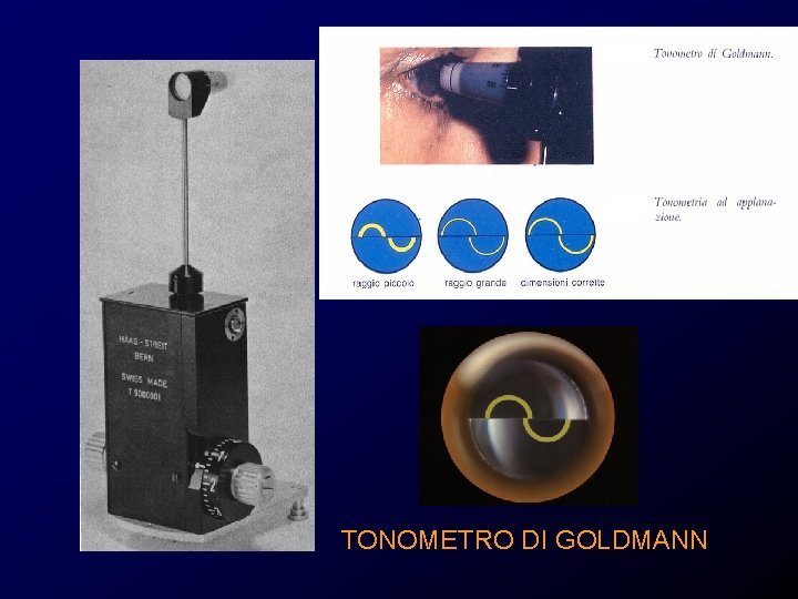 TONOMETRO DI GOLDMANN TONOMETRO DI GOLDMANN