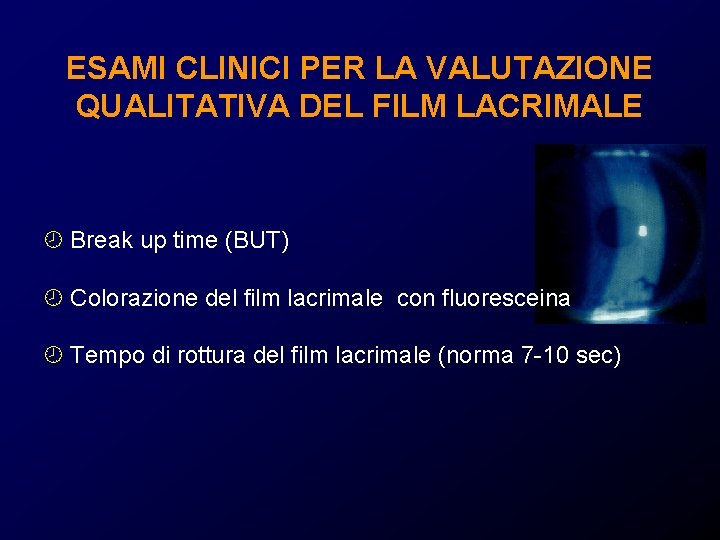 ESAMI CLINICI PER LA VALUTAZIONE QUALITATIVA DEL FILM LACRIMALE ¾ Break up time (BUT) ESAMI CLINICI PER LA VALUTAZIONE QUALITATIVA DEL FILM LACRIMALE ¾ Break up time (BUT)