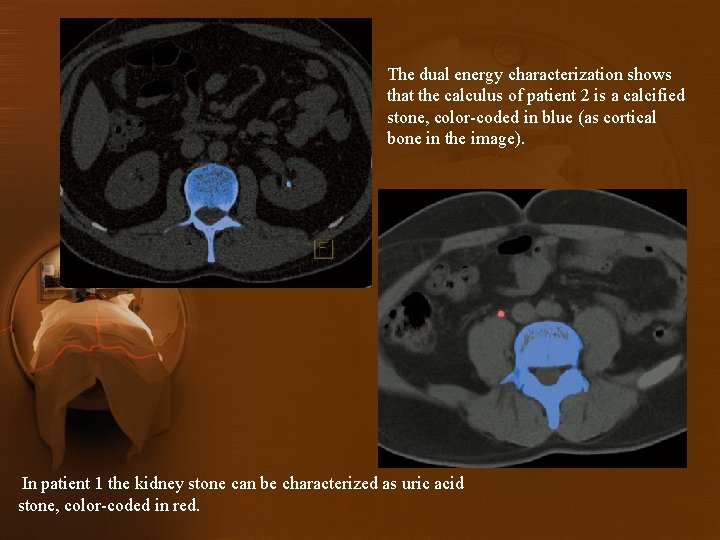 The dual energy characterization shows that the calculus of patient 2 is a calcified