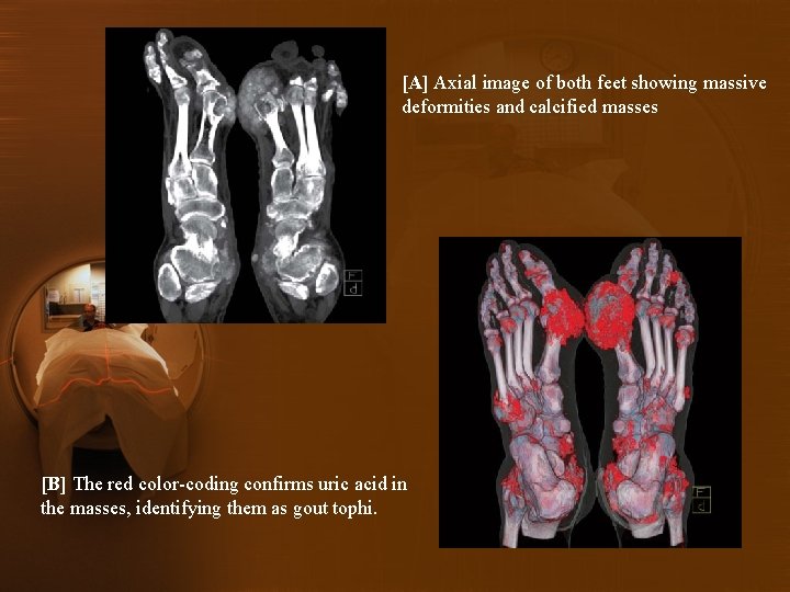 [A] Axial image of both feet showing massive deformities and calcified masses [B] The