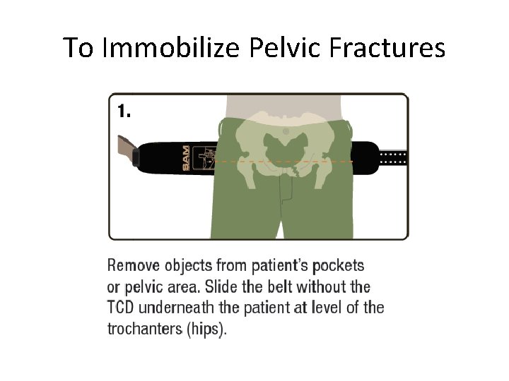 To Immobilize Pelvic Fractures 