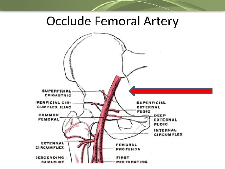 Occlude Femoral Artery 