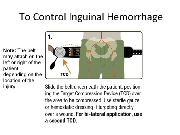 To Control Inguinal Hemorrhage Note: The belt may attach on the left or right