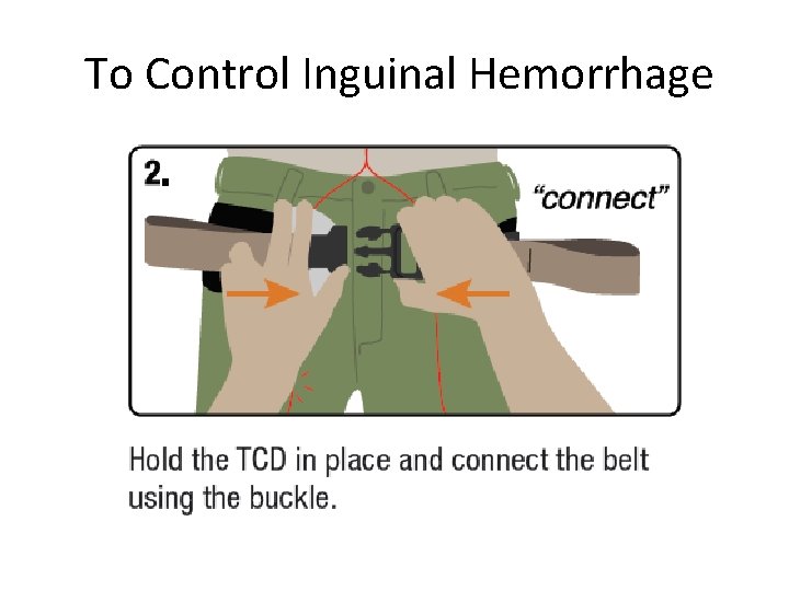 To Control Inguinal Hemorrhage 