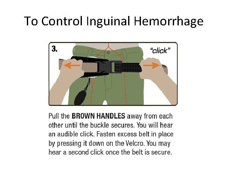 To Control Inguinal Hemorrhage 