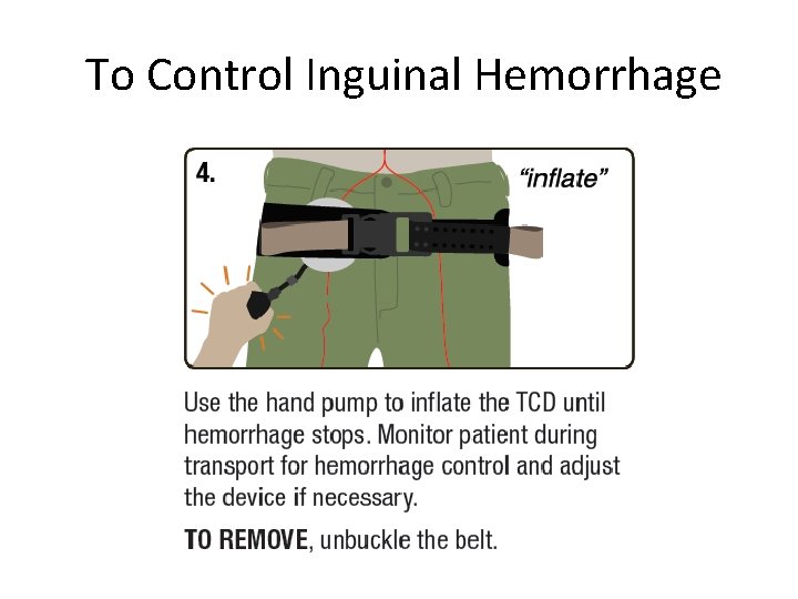 To Control Inguinal Hemorrhage 