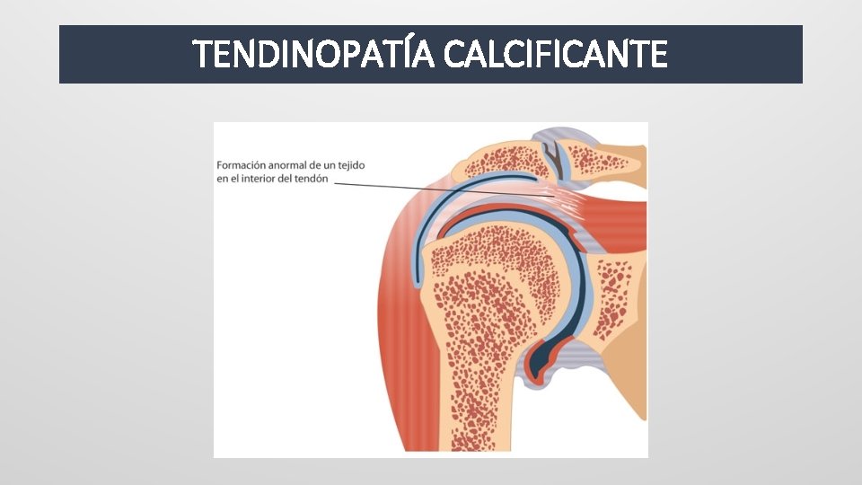 TENDINOPATÍA CALCIFICANTE 