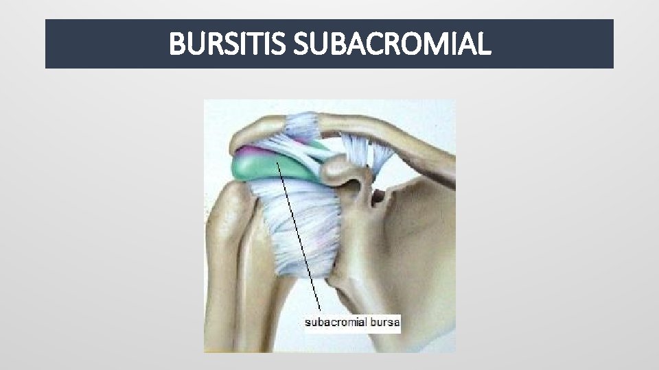 BURSITIS SUBACROMIAL 