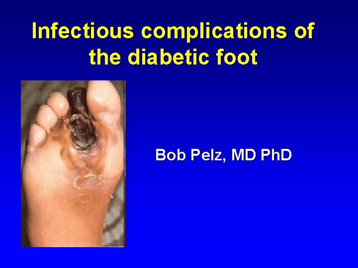 Infectious complications of the diabetic foot Bob Pelz, MD Ph. D 
