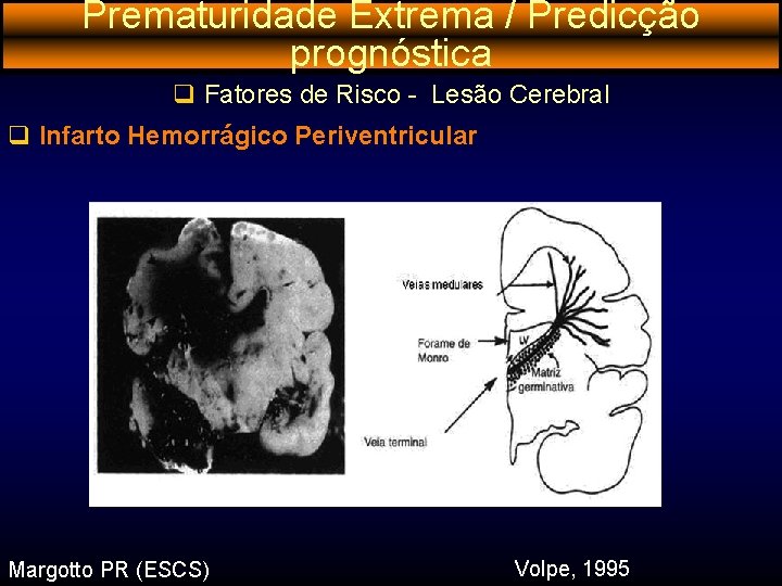 Prematuridade Extrema / Predicção prognóstica q Fatores de Risco - Lesão Cerebral q Infarto