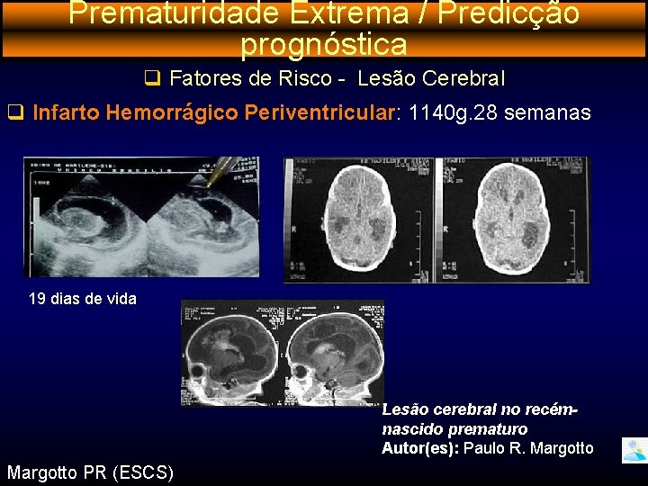 Prematuridade Extrema / Predicção prognóstica q Fatores de Risco - Lesão Cerebral q Infarto