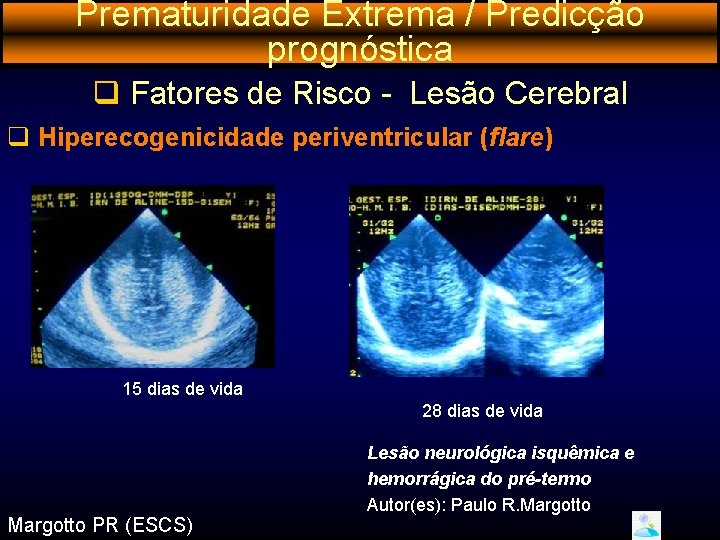 Prematuridade Extrema / Predicção prognóstica q Fatores de Risco - Lesão Cerebral q Hiperecogenicidade