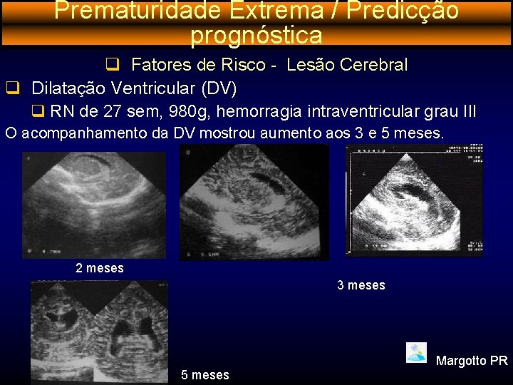 Prematuridade Extrema / Predicção prognóstica q Fatores de Risco - Lesão Cerebral q Dilatação