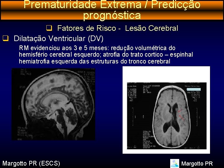 Prematuridade Extrema / Predicção prognóstica q Fatores de Risco - Lesão Cerebral q Dilatação