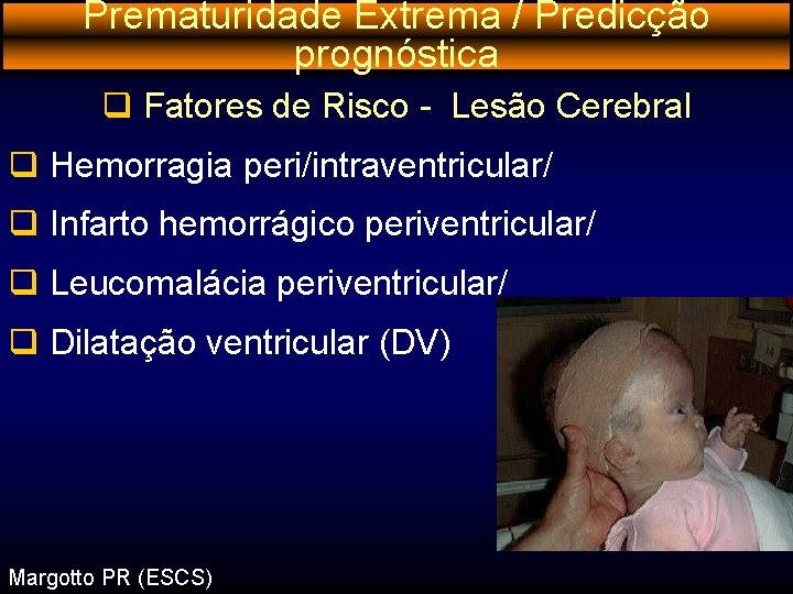 Prematuridade Extrema / Predicção prognóstica q Fatores de Risco - Lesão Cerebral q Hemorragia