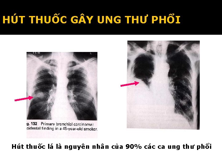 HÚT THUỐC G Y UNG THƯ PHỔI Hút thuốc lá là nguyên nhân của