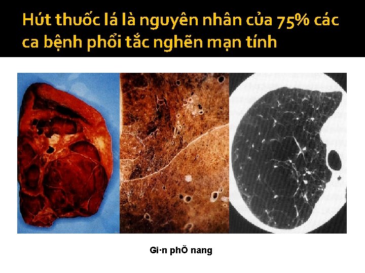 Hút thuốc lá là nguyên nhân của 75% các ca bệnh phổi tắc nghẽn