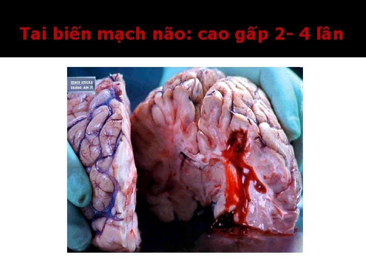 Tai biến mạch não: cao gấp 2 - 4 lần 