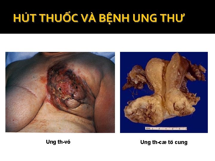 HÚT THUỐC VÀ BỆNH UNG THƯ Ung th vó Ung th cæ tö cung