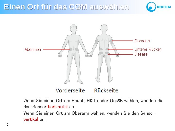 Einen Ort für das CGM auswählen Oberarm Abdomen Unterer Rücken Gesäss Wenn Sie einen