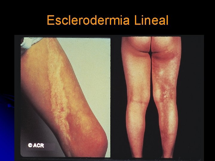 Esclerodermia Lineal Esclerodermia Lineal