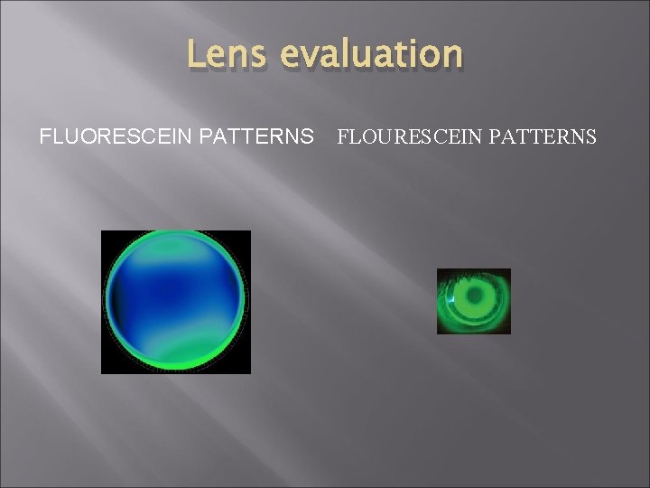 Lens evaluation FLUORESCEIN PATTERNS FLOURESCEIN PATTERNS 