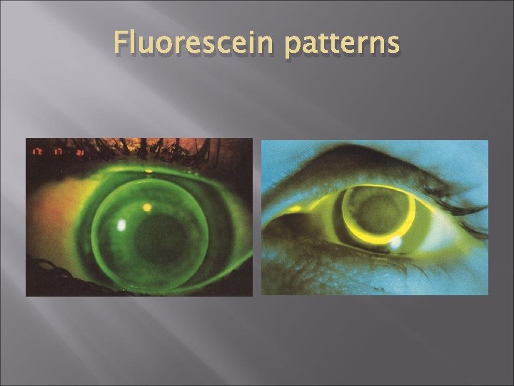 Fluorescein patterns 