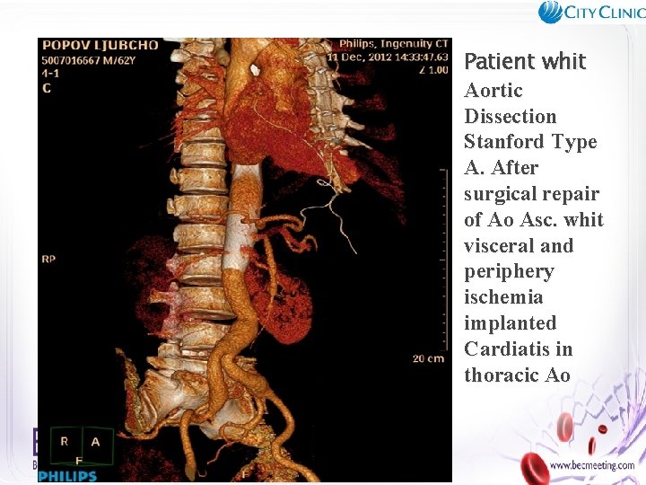 Patient whit Aortic Dissection Stanford Type А. After surgical repair of Ao Asc. whit