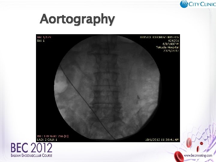 Aortography 