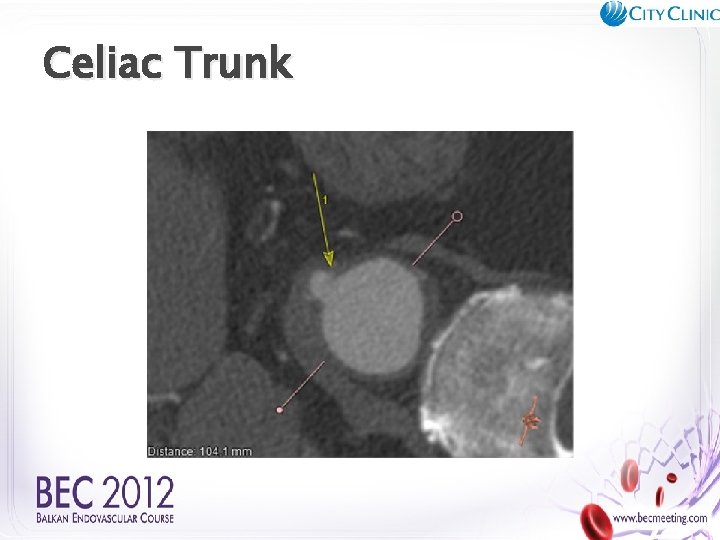 Celiac Trunk 