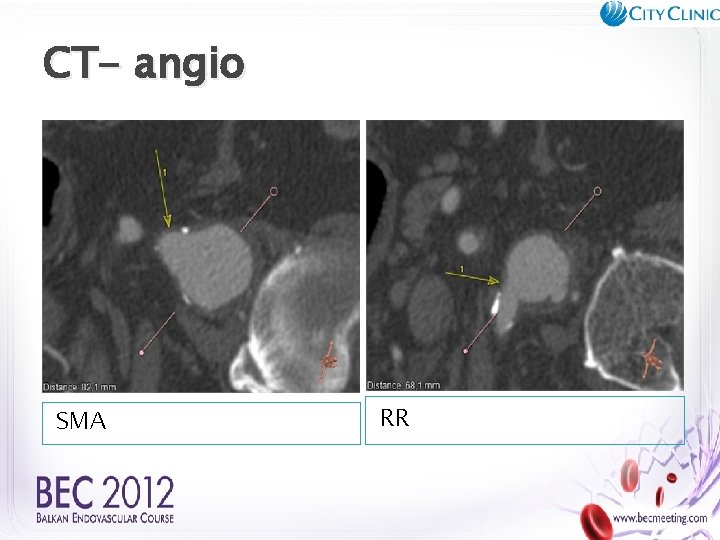 CT- angio SMA RR 