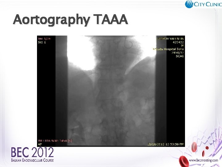 Aortography TAAA 