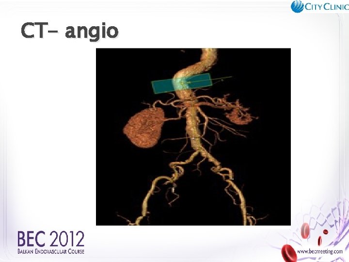 CT- angio 