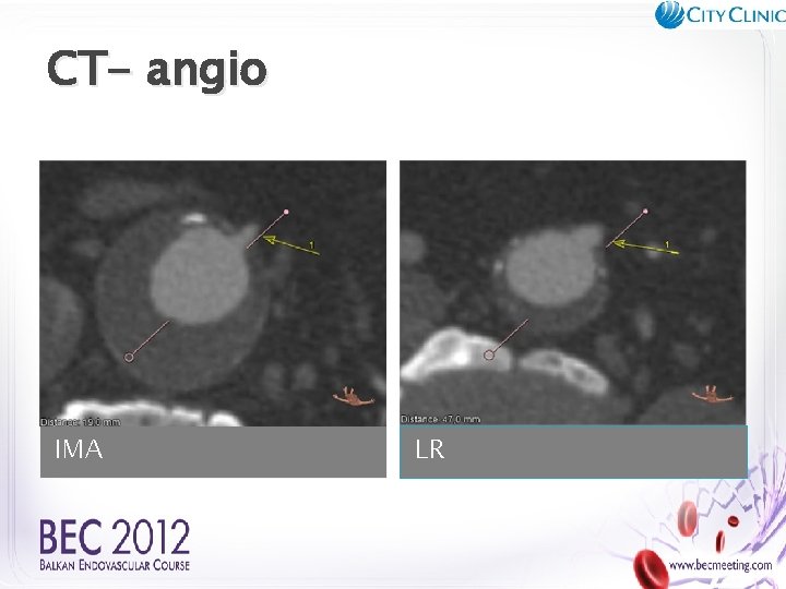 CT- angio IMA LR 