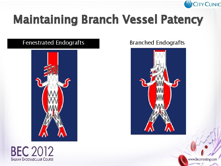 Maintaining Branch Vessel Patency Fenestrated Endografts Branched Endografts 