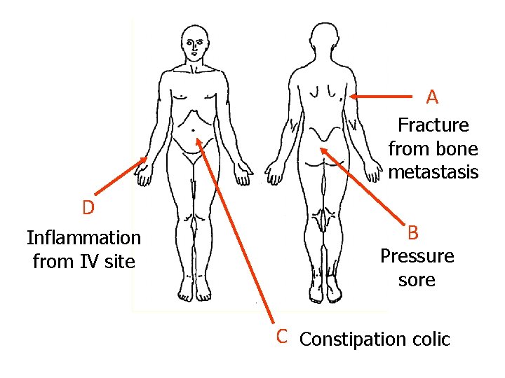 A Fracture from bone metastasis D Inflammation from IV site B Pressure sore C