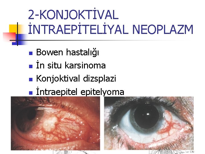 2 -KONJOKTİVAL İNTRAEPİTELİYAL NEOPLAZM n n Bowen hastalığı İn situ karsinoma Konjoktival dizsplazi İntraepitelyoma 2 -KONJOKTİVAL İNTRAEPİTELİYAL NEOPLAZM n n Bowen hastalığı İn situ karsinoma Konjoktival dizsplazi İntraepitelyoma