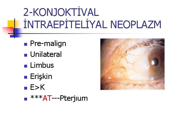 2 -KONJOKTİVAL İNTRAEPİTELİYAL NEOPLAZM n n n Pre-malign Unilateral Limbus Erişkin E>K ***AT---Pterjıum 2 -KONJOKTİVAL İNTRAEPİTELİYAL NEOPLAZM n n n Pre-malign Unilateral Limbus Erişkin E>K ***AT---Pterjıum