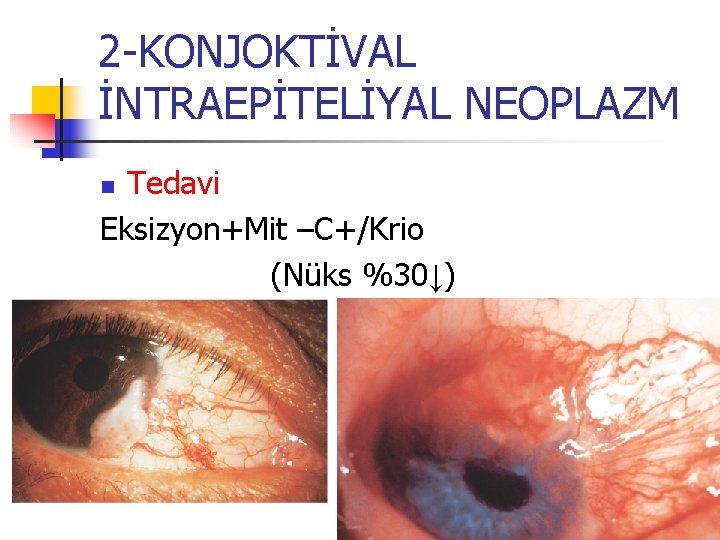2 -KONJOKTİVAL İNTRAEPİTELİYAL NEOPLAZM Tedavi Eksizyon+Mit –C+/Krio (Nüks %30↓) n 2 -KONJOKTİVAL İNTRAEPİTELİYAL NEOPLAZM Tedavi Eksizyon+Mit –C+/Krio (Nüks %30↓) n