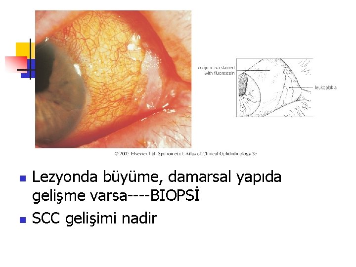 2 -KONJOKTİVAL İNTRAEPİTELİYAL NEOPLAZM n n Lezyonda büyüme, damarsal yapıda gelişme varsa----BIOPSİ SCC gelişimi 2 -KONJOKTİVAL İNTRAEPİTELİYAL NEOPLAZM n n Lezyonda büyüme, damarsal yapıda gelişme varsa----BIOPSİ SCC gelişimi