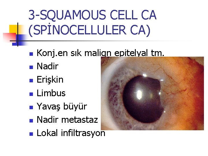 3 -SQUAMOUS CELL CA (SPİNOCELLULER CA) n n n n Konj. en sık malign 3 -SQUAMOUS CELL CA (SPİNOCELLULER CA) n n n n Konj. en sık malign